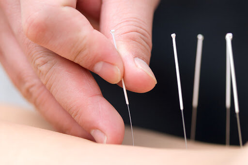 dry needling Melbourne